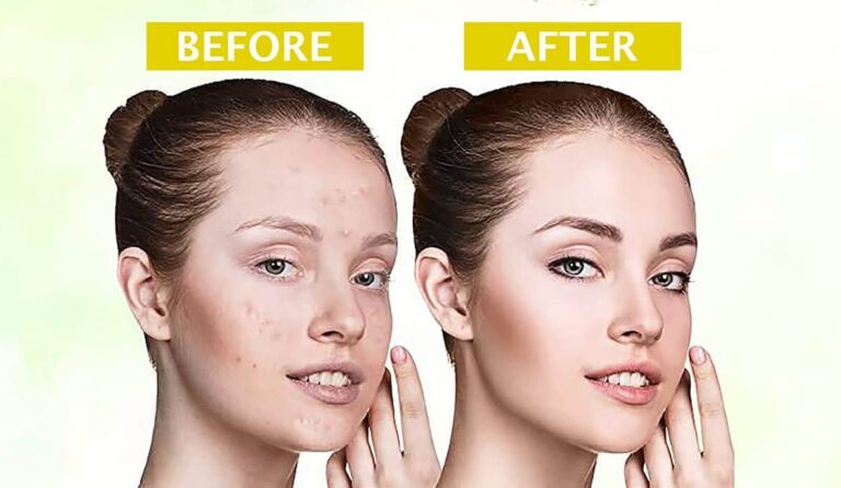 multani-mitti-face-pack-04